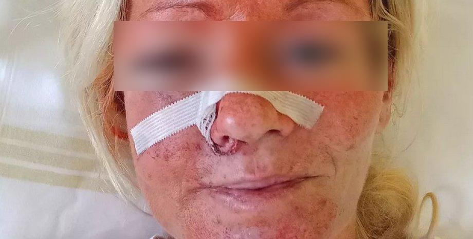 Відкритий перелом щелепи та кісток носа: у Чехії чоловік напав на  двох українок